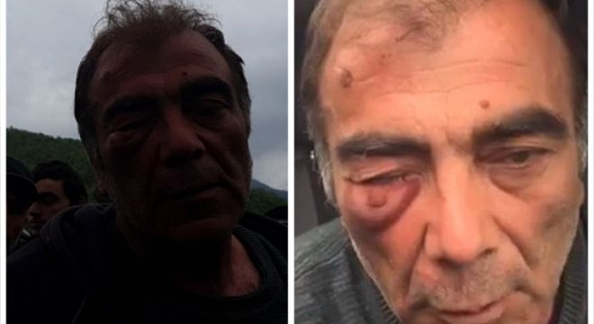"თვალში დამიმიზნეს და მესროლეს..." -  რა მდგომარეობაშია კაცი, რომელიც დღეს პანკისში ყველაზე მეტად დაზარალდა