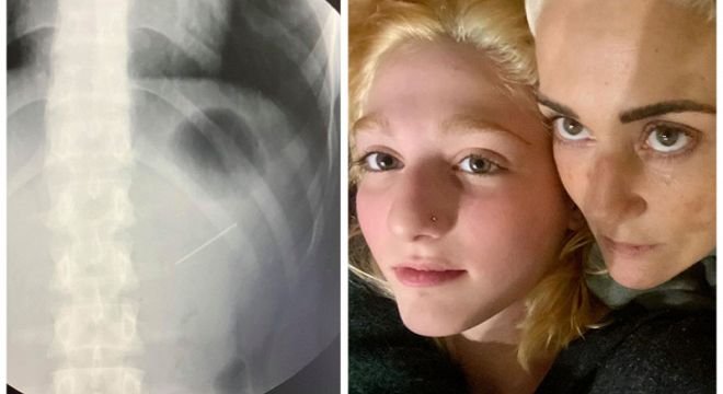 ნანიკო ხაზარაძის შვილს დაცემინების დროს ნემსი გადაეყლაპა - ტელეწამყვანი სოციალურ ქსელში რენტგენის სურათს აქვეყნებს