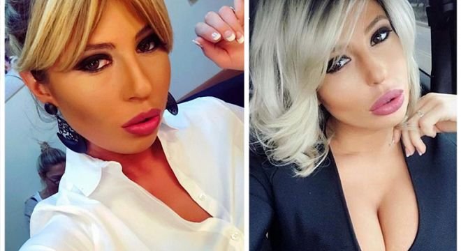 "ეს შეშუპებაც მიქრება და მერე ვეღარ იტყვით ცარიელი ტრაკ**ო" - როგორ გამოიყურება თამო ვაშალომიძე ცხვირის ოპერაციის გაკეთების შემდეგ