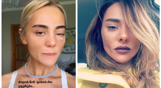 "დილემის წინაშე ვარ მეგობრებო, მირჩიეთ როგორ მოვიქცე, ხანდახან ვიხრჩობი, თვალები მიხივდება, სპაზმები მახრჩობს... უკვე შევჯექი ამ წამლებზე" - მარი ნაკანი გახმარებას ითხოვს