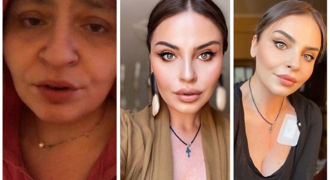 "მარცხენა ფოტოზე კარგად ჩანს როგორმა განადგურებულმა დავასრულე 2018 წლის დეკემბერში... დღეს დავასრულე მკურნალობა და მარჯვენა ფოტო დღევანდელია . ხედავთ განსხვავებას და ფერფლისგან აღდგომას" - მარიამ სირბილაძე