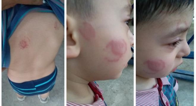 "ჩემი შვილი თანაჯგუფელმა დაკბინა... იკითხავთ , რატომ ვწერ ეხლა პოსტს, ამიტომ გეტყვით რომ..." - გორში ბავშვი ბაღში დაკბინეს