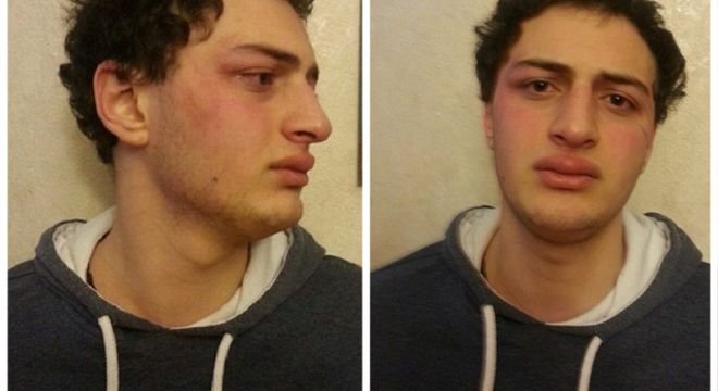 უნივერსიტეტიდან შინისკენ მივდიოდი, უკვე ბახტრიონზე ვიყავი, ოთახში როგორც კი შემიყვანეს, მაშინვე სახეში ხელი მომხვდა, ვერ მივხვდი რა ხდებოდა... თუ არ აღიარებ, მაშინ წამალს ჩაგიდებთ და 6 წლამდე პატიმრობას მოგისჯიანო..." - რას ყვება 20 წლის სტუდენტი, რომელიც პოლიციელებმა სასტიკად სცემეს