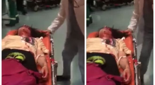 ახალგაზრდა გოგონამ, რომელიც საავადმყოფოში სახის დაზიანებით გადაიყვანეს თვალი დაკარგა