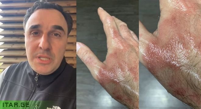 რეანიმაციაში ამ კადრების გადაღების შემდეგ დამეწყო ხელების წვა, არც არაფერი მშველის და არც ვიცი რა ვქნა... - რას ყვება ოპერატორი, რომელმაც პირველი საუნივერსიტეტო კლინიკის რეანიმაციაში კორონა ვირუსით დაავადებული ხალხი გადაიღო