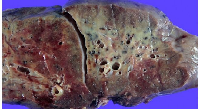 როგორ გამოიყურება იმ ადამიანის ფილტვები, რომელმაც ვირუსი დაამარცხა