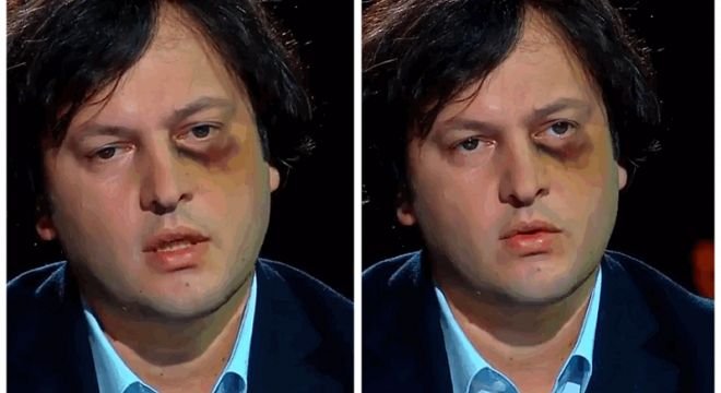 თვალჩალურჯებული ირაკლი კობახიძის ინტერვიუ - ვინ ჩაულურჯა პარლამენტის ყოფილ თავმჯდომარეს თვალი და რა მოხდა რეალურად