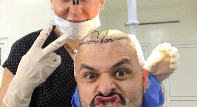 როგორი იქნება "ჩცდ"-ს აჩიკო მომდევნო სეზონში, რომელმაც თმა გადაინერგა
