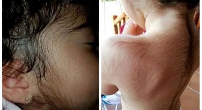 ამ წამლის მიღების შემდეგ ბავშვს მთელს სხეულზე თმები ამოუვიდა - გაფრთხილება მშობლებს